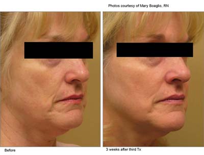 3D Skin Rejuvenation 